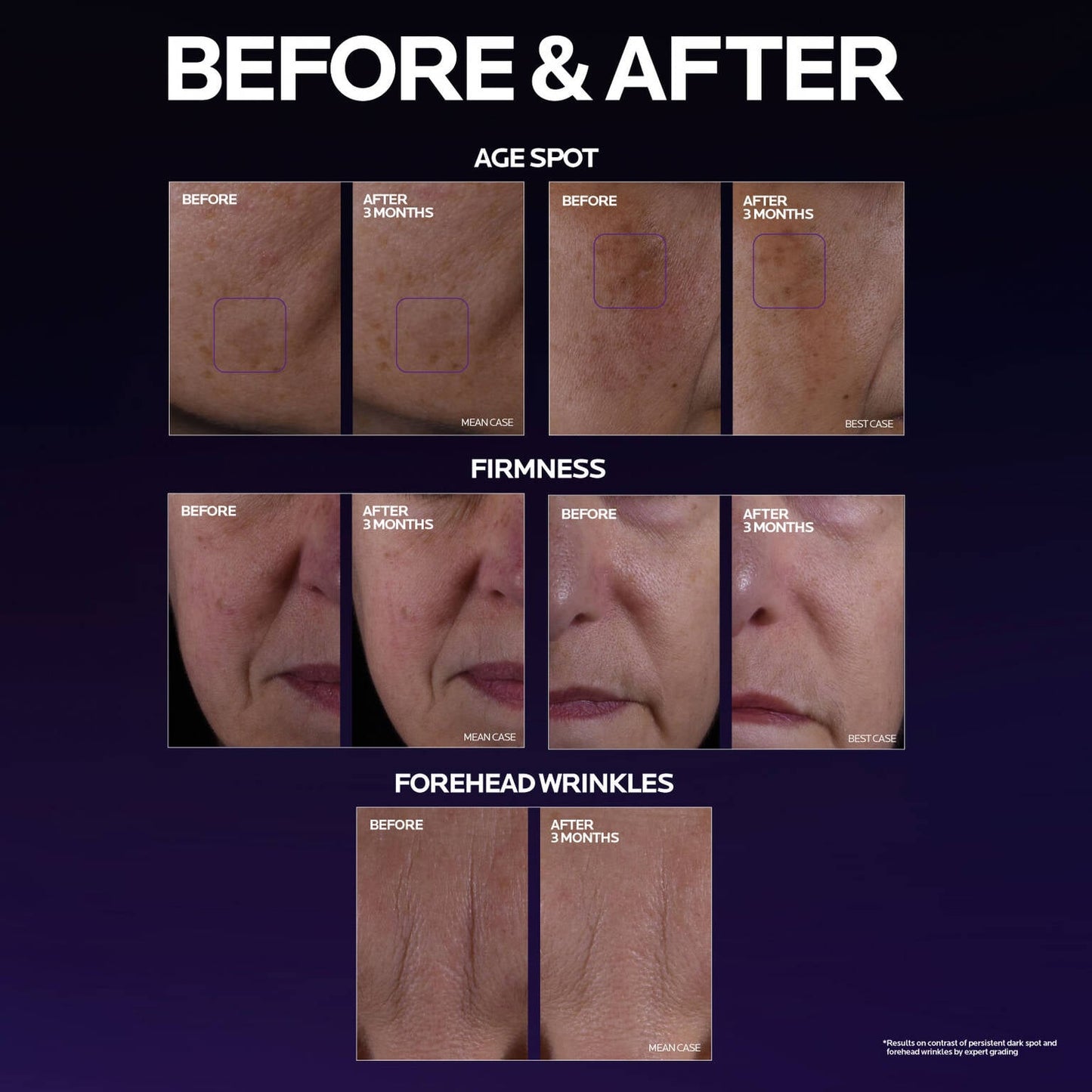 mela-b3-double-dose-discoloration-treatment-with-melasyltm-i7 MelaB3_DD_BTF_BeforeAfter_1500x1500_5.jpg