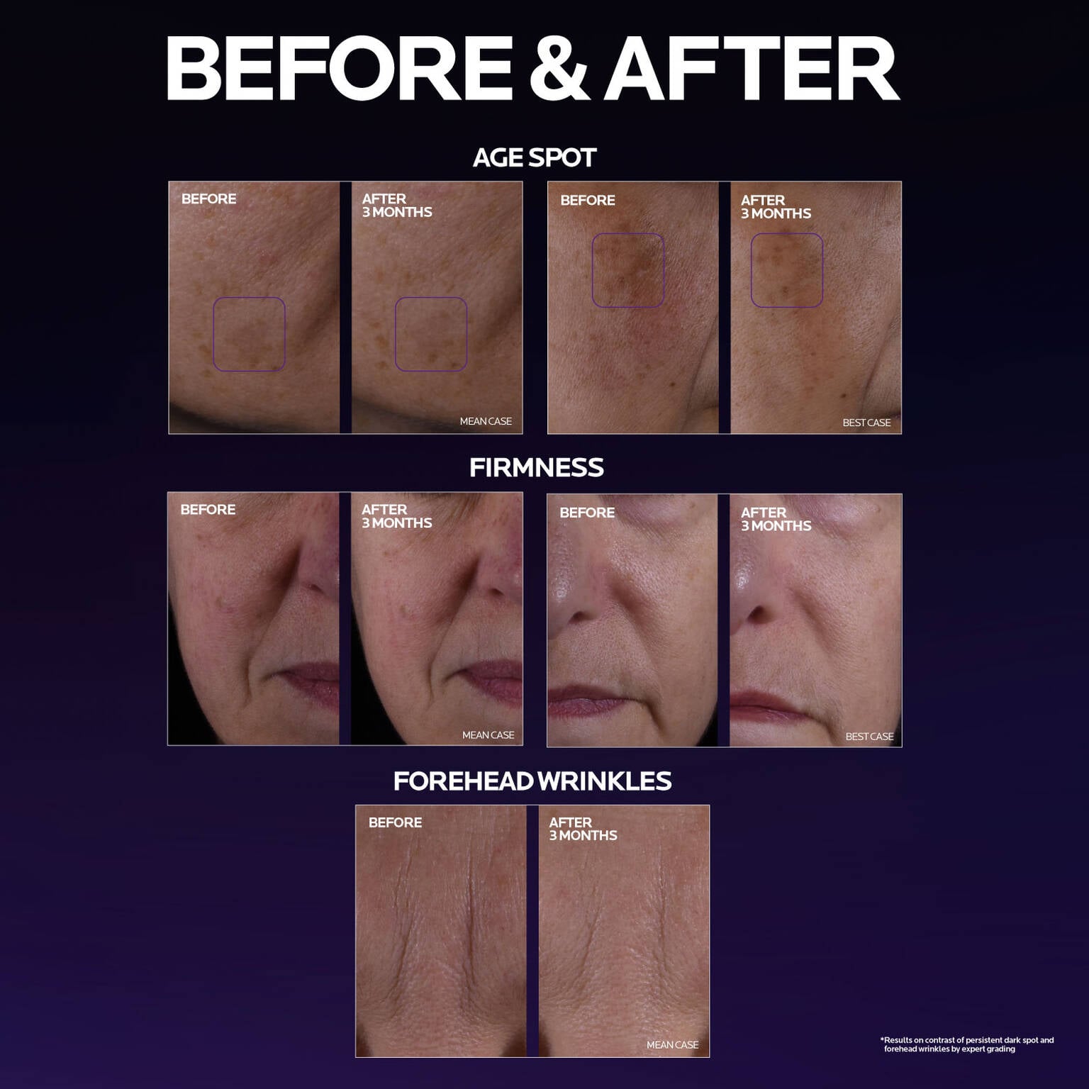 mela-b3-double-dose-discoloration-treatment-with-melasyltm-i7 MelaB3_DD_BTF_BeforeAfter_1500x1500_5.jpg
